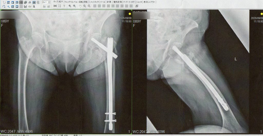 大腿骨転子部骨折の手術後のレントゲン写真